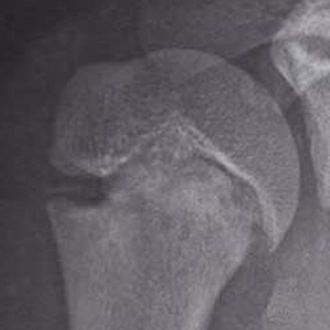 リトルリーガーズ ショルダー