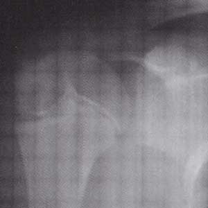 野球肩 リトルリーガーズ ショルダー