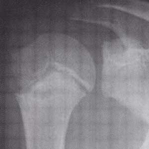 野球肩 リトルリーガーズ ショルダー